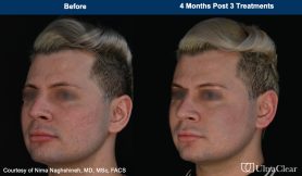 UltraClear photos of before and after results