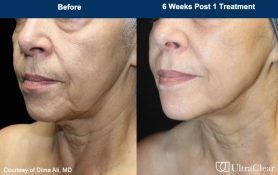 UltraClear photos of before and after results