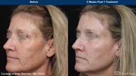 UltraClear photos of before and after results