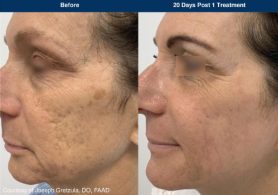 UltraClear photos of before and after results